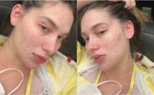 virginia fonseca é internada em menos de 24 hrs após reação alérgica: “continuei inchando”