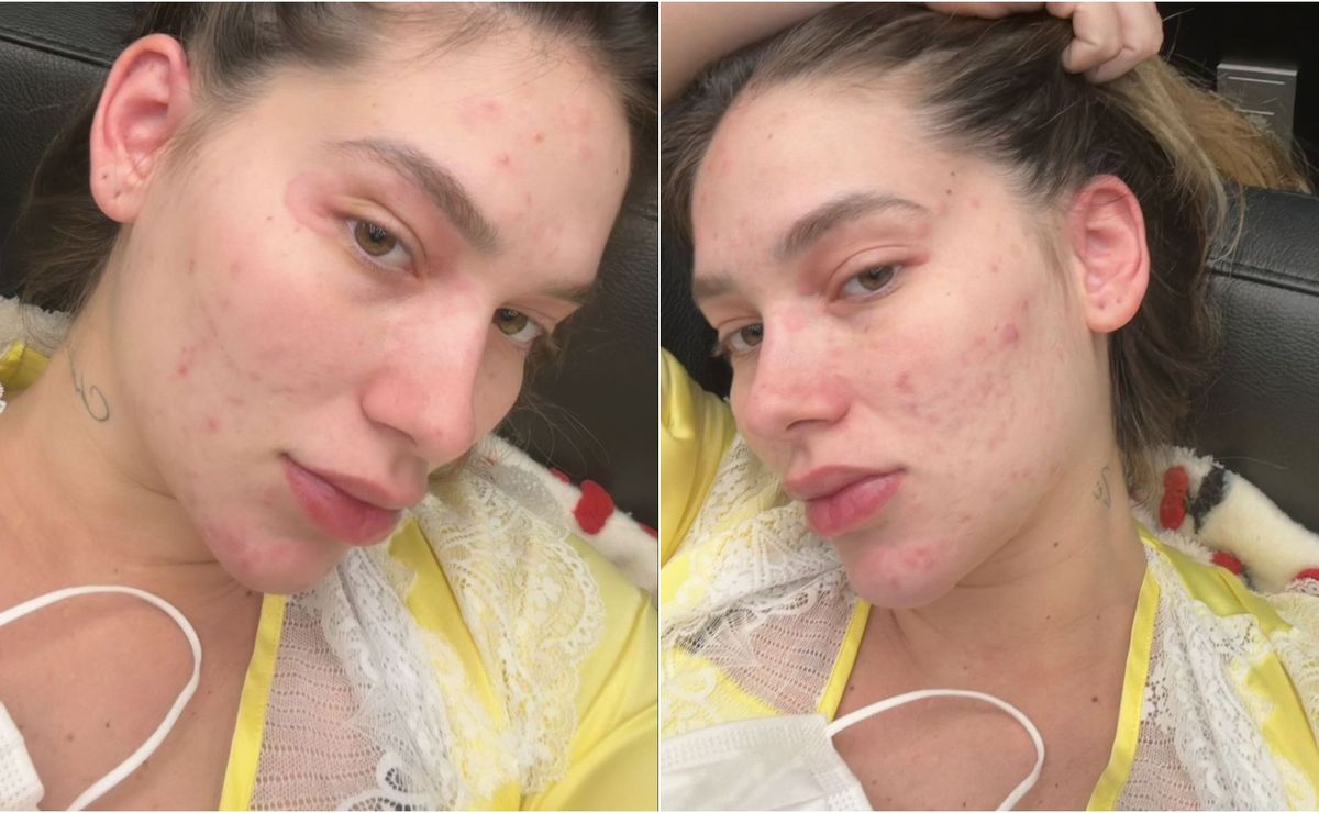 virginia fonseca é internada em menos de 24 hrs após reação alérgica: “continuei inchando”